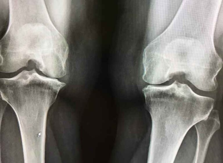 Approches alternatives : Comment soigner l’arthrose naturellement